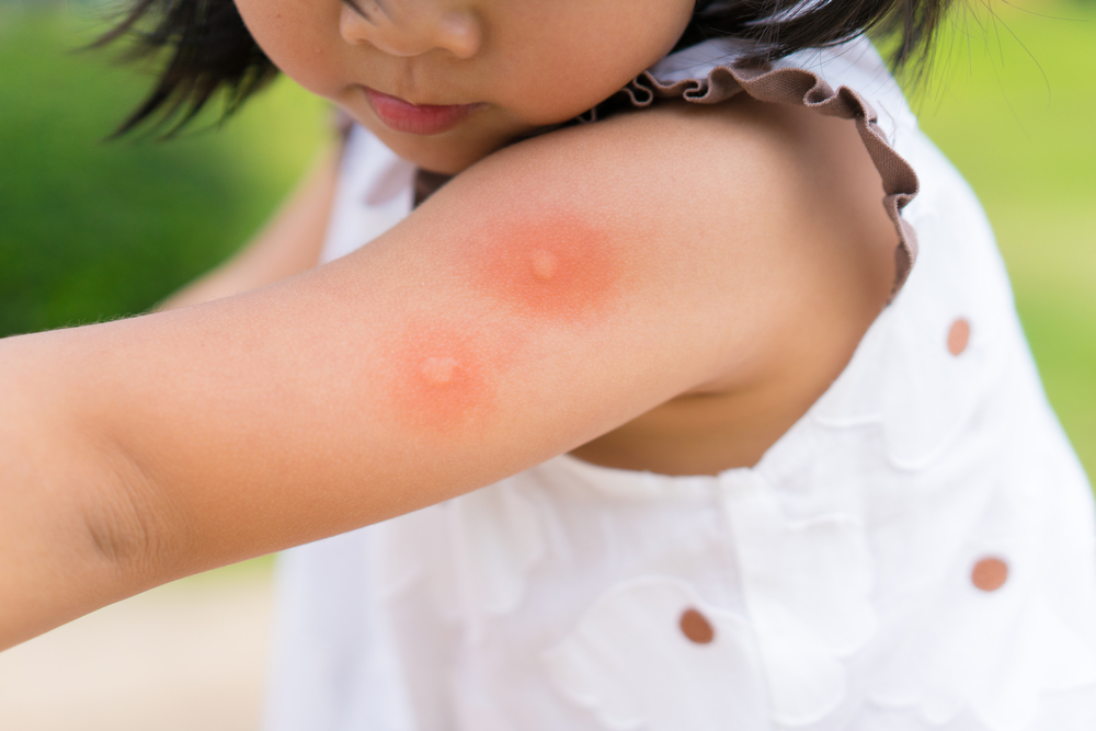 Mosquito bites itch because the body's immune system produces histamines.